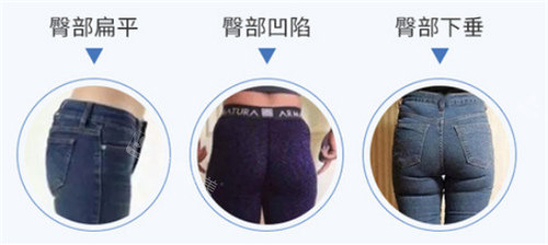 臀部問題展示圖