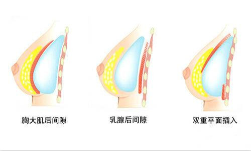 假体植入方式示意图