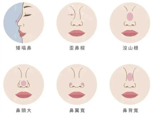 各种问题鼻型示意图 各种问题鼻型示意图