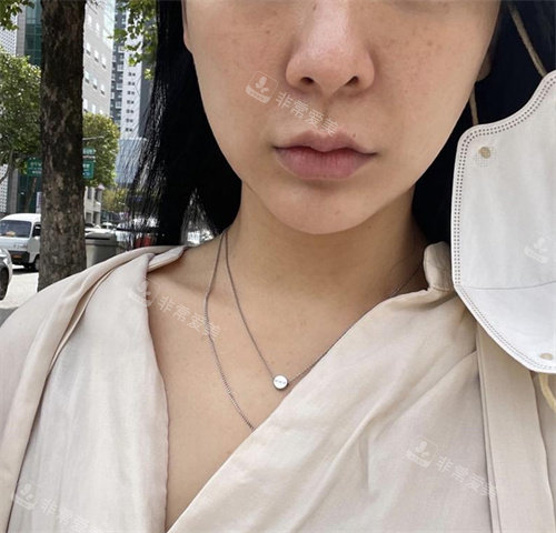 韓國(guó)赫爾希整形外科術(shù)前圖 韓國(guó)赫爾希整形外科術(shù)前圖