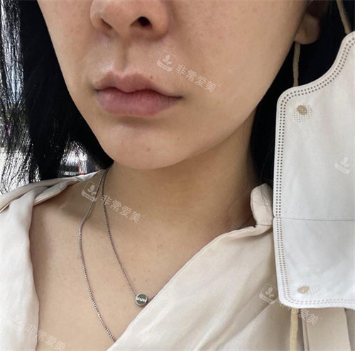 韓國(guó)赫爾希整形外科迷你提升術(shù)前圖 韓國(guó)赫爾希整形外科迷你提升術(shù)前圖