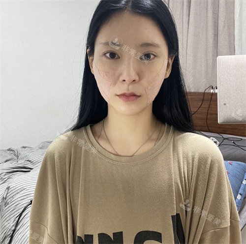 韓國(guó)赫爾希整形外科迷你提升術(shù)后圖 韓國(guó)赫爾希整形外科迷你提升術(shù)后圖