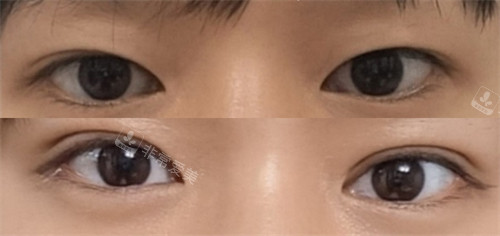 韩国赫尔希整形双眼皮手术术前术后对比图