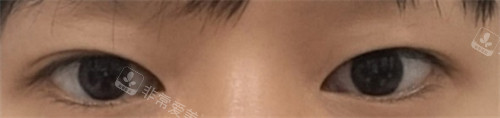 韩国赫尔希整形双眼皮手术术前图