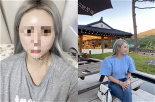 韓國赫爾希迷你輪廓提升術(shù)后圖片 韓國赫爾希迷你輪廓提升術(shù)后圖片