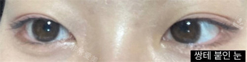 手術(shù)前照片 手術(shù)前照片