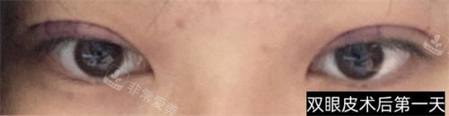 手術(shù)后1天 手術(shù)后1天