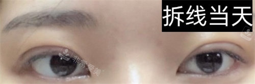 手術(shù)拆線當(dāng)天 手術(shù)拆線當(dāng)天