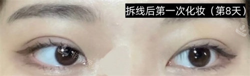 手術(shù)拆線后化妝圖 手術(shù)拆線后化妝圖