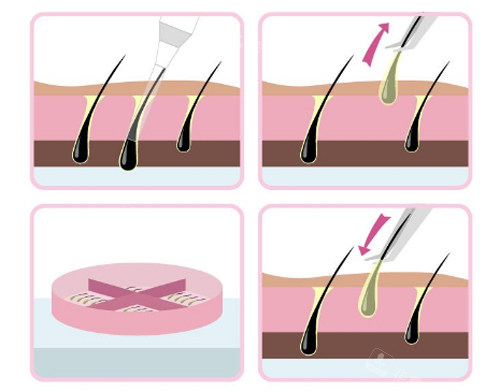 毛发移植过程图示