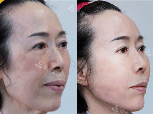 面部提升手术前后变化图片