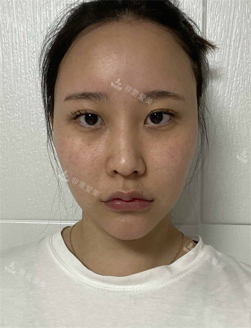 整形手術前照片 整形手術前照片