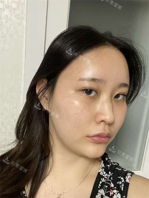 整形手術前照片 整形手術前照片