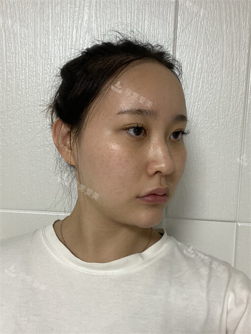整形手術前照片 整形手術前照片
