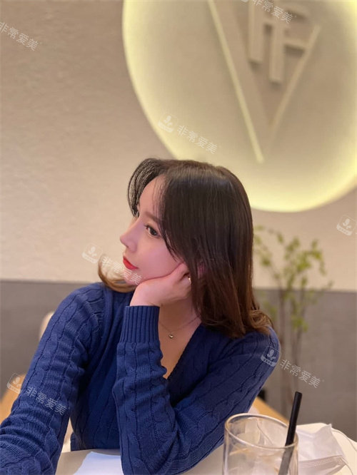 眼鼻吸脂術整形手術3周后照片 眼鼻吸脂術整形手術3周后照片