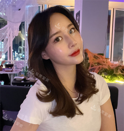 眼鼻吸脂術整形手術3周后照片 眼鼻吸脂術整形手術3周后照片