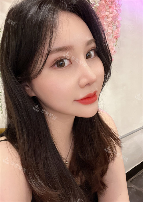 眼鼻吸脂術整形手術6個月后照片 眼鼻吸脂術整形手術6個月后照片