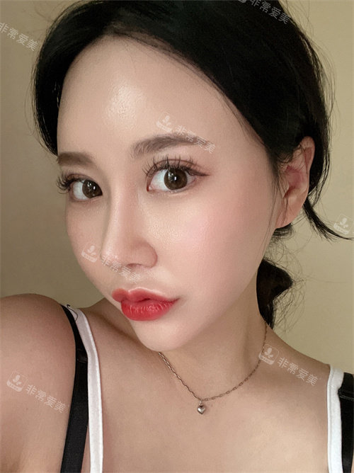 眼鼻吸脂術整形手術6個月后照片 眼鼻吸脂術整形手術6個月后照片