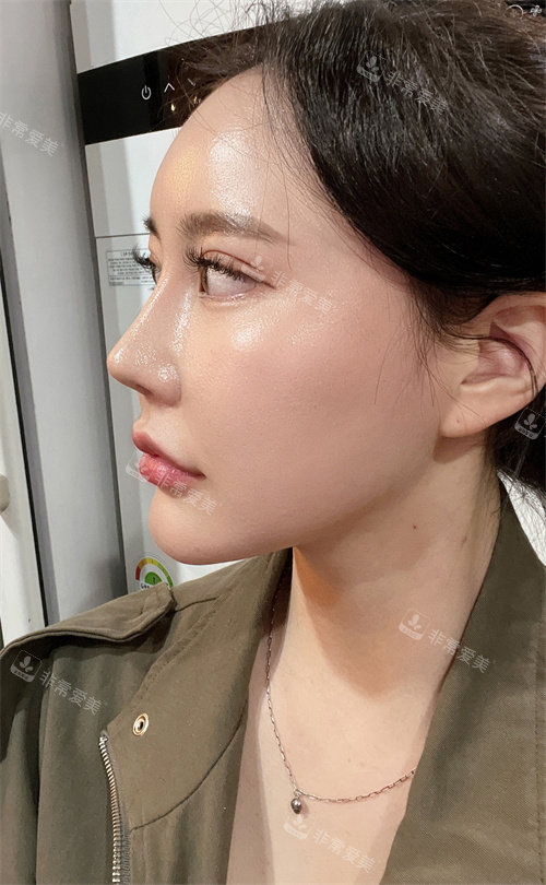 眼鼻吸脂術整形手術6個月后照片 眼鼻吸脂術整形手術6個月后照片