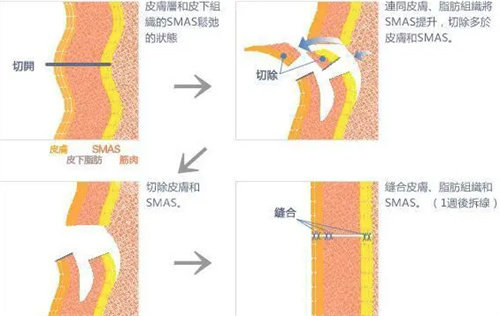 拉皮手術(shù)操作圖