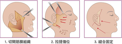 拉皮手術(shù)過(guò)程圖 拉皮手術(shù)過(guò)程圖