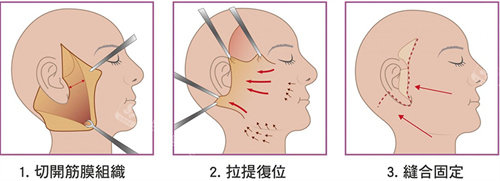 拉皮手术过程图