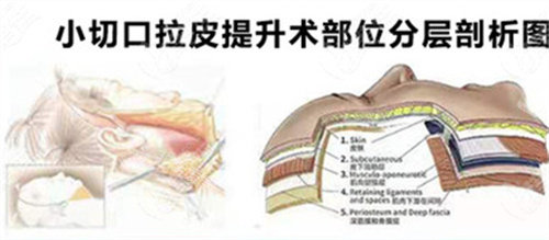 小切口拉皮手術(shù)圖