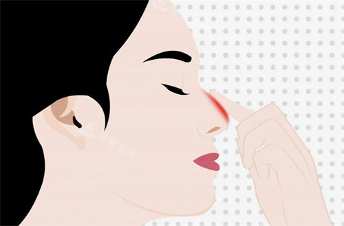 鼻头发炎动画展示图 鼻头发炎动画展示图