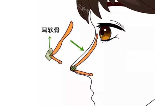 耳软骨隆鼻动画展示图 耳软骨隆鼻动画展示图