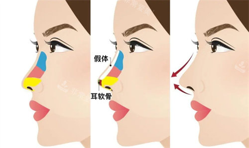 复合隆鼻动画演示图 复合隆鼻动画演示图