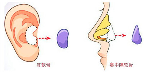 自体软骨隆鼻流程图 自体软骨隆鼻流程图