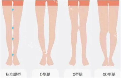 标准腿型与XO腿型对比图 标准腿型与XO腿型对比图