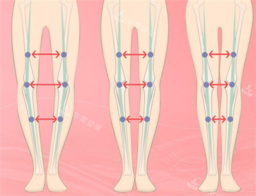 不同骨骼情况腿型展示图