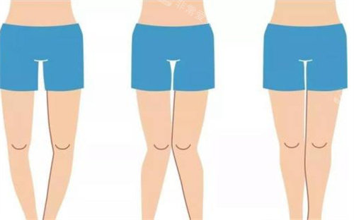 XO型腿动画展示图 XO型腿动画展示图