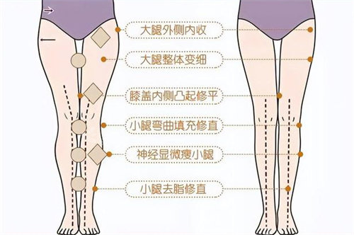 直腿术方案设计图 直腿术方案设计图
