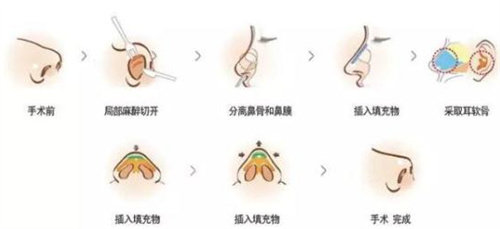 假体隆鼻手术操作图