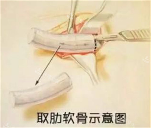 肋骨圖 肋骨圖