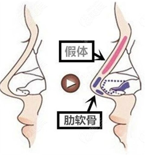 肋软骨隆鼻图片