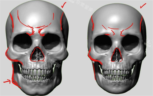 颌面整形模拟图