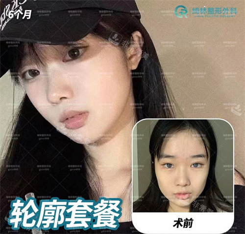 韓國綺林整形醫(yī)院輪廓手術(shù)對比圖 韓國綺林整形醫(yī)院輪廓手術(shù)對比圖