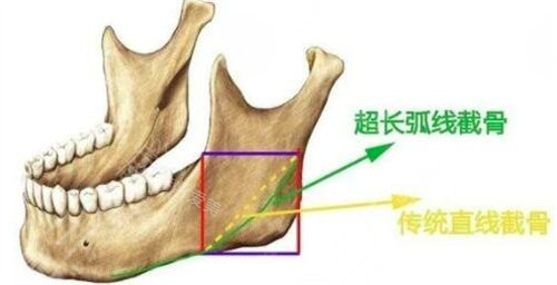 削骨圖片展示圖