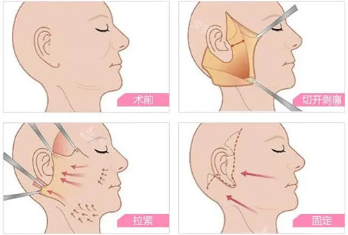 拉皮手術(shù)流程圖 拉皮手術(shù)流程圖