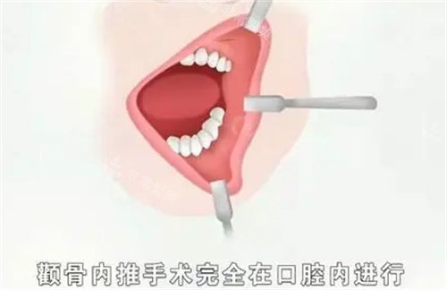 顴骨內(nèi)推術(shù)在口腔內(nèi)進(jìn)行圖