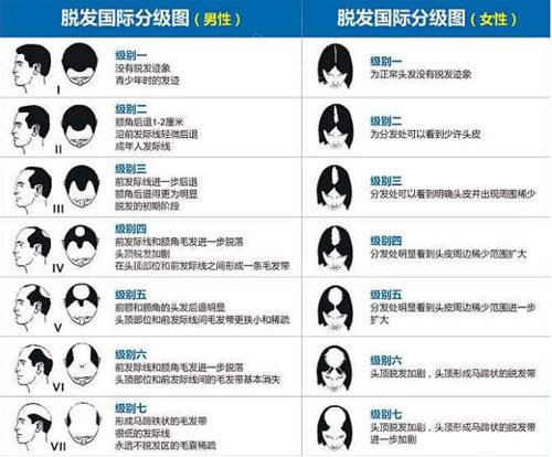 脱发程度展示图 脱发程度展示图