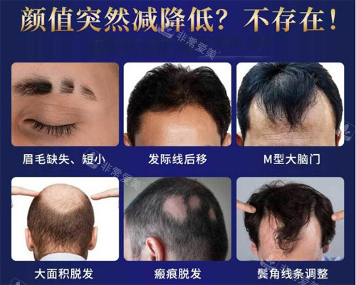 不同部位的脱发情况 不同部位的脱发情况