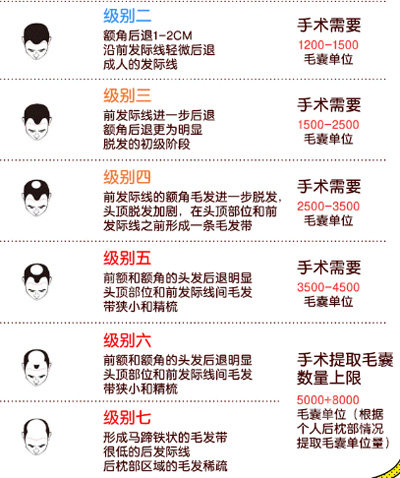 不同级别的脱发情况 不同级别的脱发情况