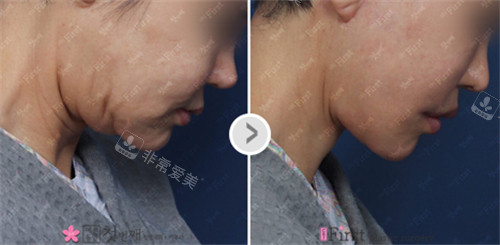 韩国初见整形外科颈部提升前后图