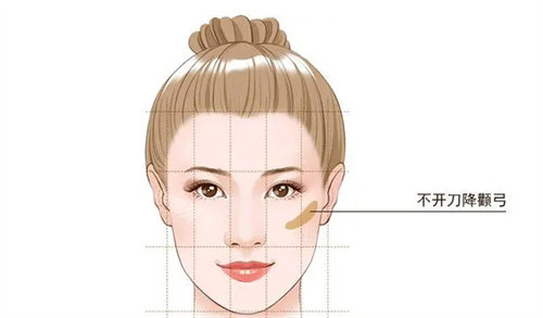 不开刀降颧骨动画图 不开刀降颧骨动画图