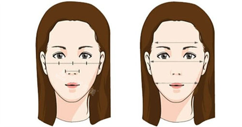 颧骨整形前后对比图