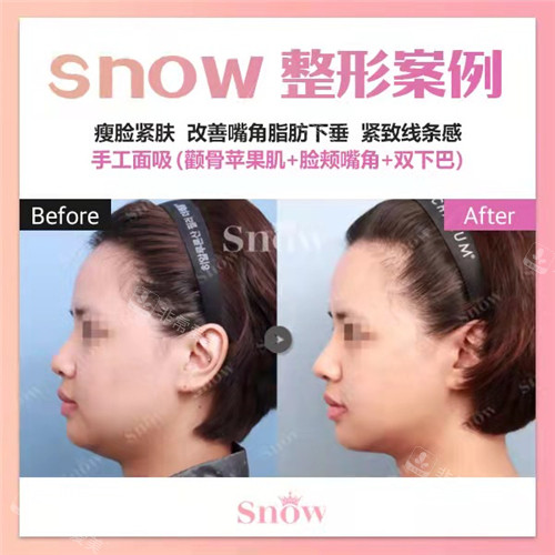 韓國(guó)SNOW整形外科面吸前后圖